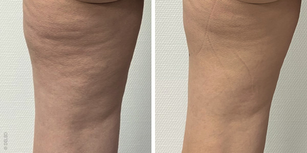 Eliminer la cellulite sur la face externe des cuisses