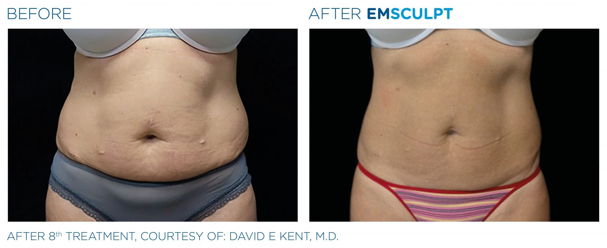 Tonification musculaire abdominale avec EMSculpt®