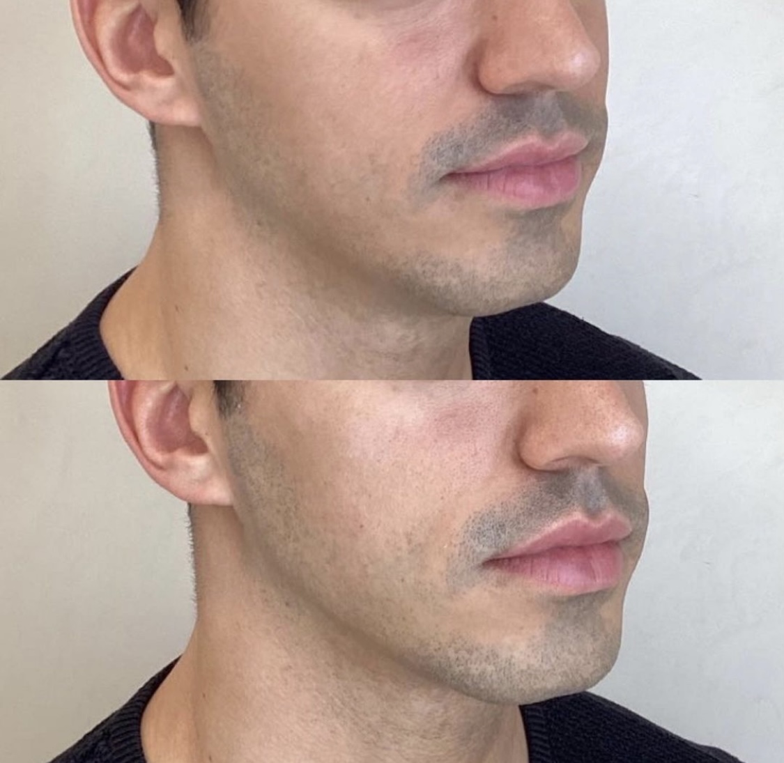 Jawline Contouring - Clinique des Champs-Elysées Bordeaux