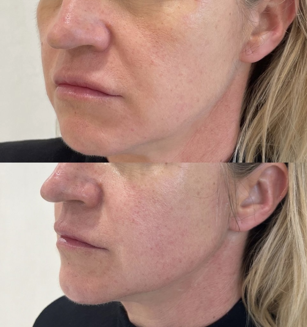 Jawline Contouring - Clinique des Champs-Elysées Bordeaux