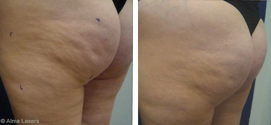 Atténuation de la cellulite avec Accent Prime™