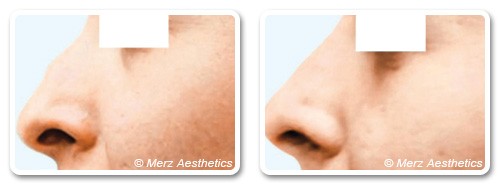Remodeler la forme du nez avec l'Acide Hyaluronique | Clinique des Champs-Elysées