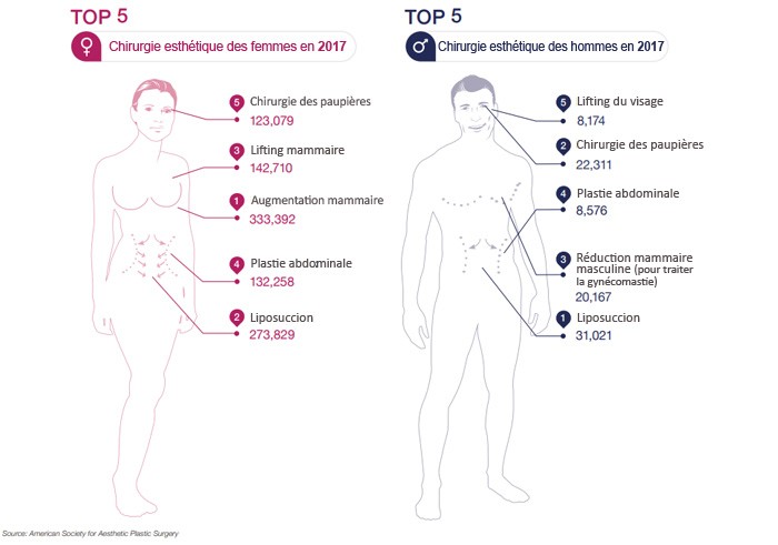 Le top 5 en chirurgie esthétique chez la femme et chez l’homme en 2017 aux Etats-Unis