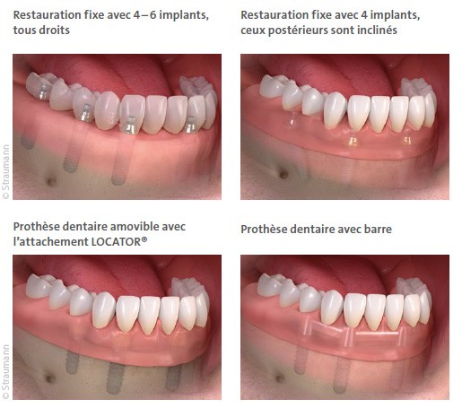 Les implants dentaires Straumann