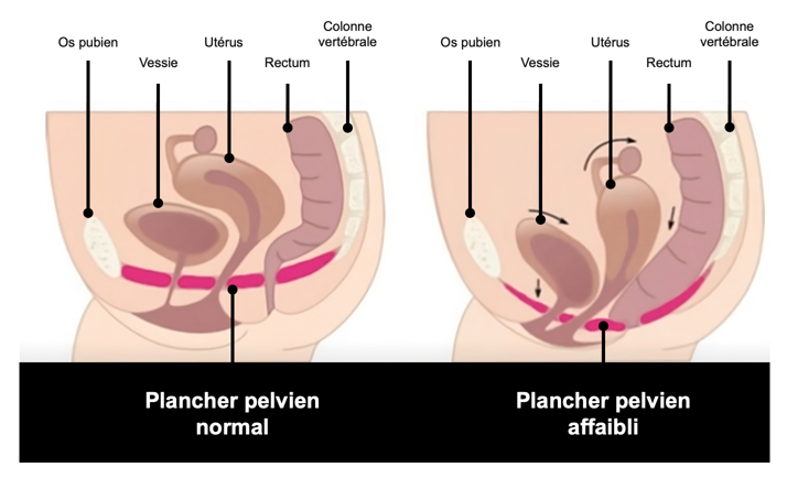 Affaissement des muscles du périnée