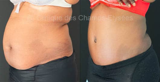 Avant-après abdominoplastie