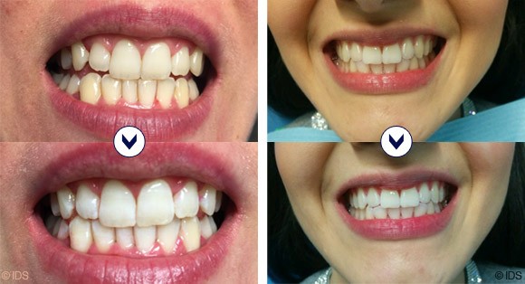 Eclaircissement des dents avec BlancOne® CLICK