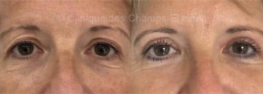 Avant-après blépharoplastie