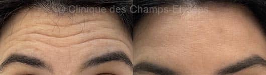 Avant-après injections Botox front