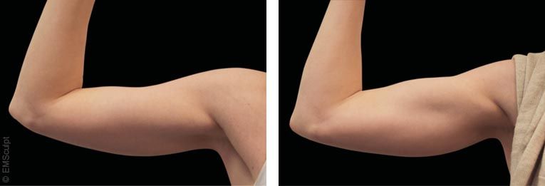 Tonification musculaire des bras avec EMSculpt®