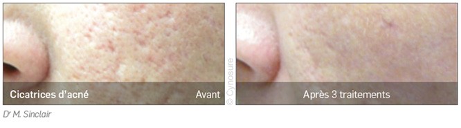 Traitement des cicatrices d’acné avec Cynosure Icon®