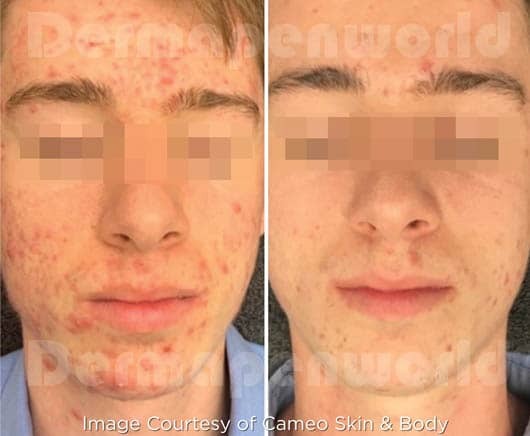 DermaPen : Traitement de l'acné