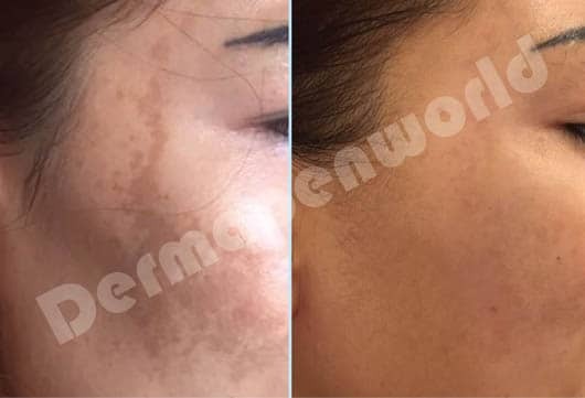 DermaPen : Atténuation du melasma (masque de grossesse)