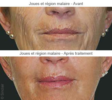 Rajeunissement du bas du visage avec Ellansé®