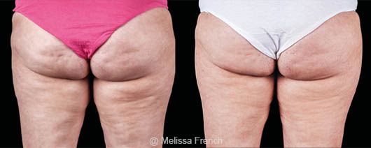 Emtone : cellulite