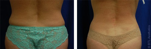 Amincissement des hanches avec Exilis Elite™