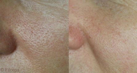 Traitement des pores dilatés avec le NCTF® 135 HA