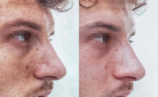Avant-après Hydrafacial