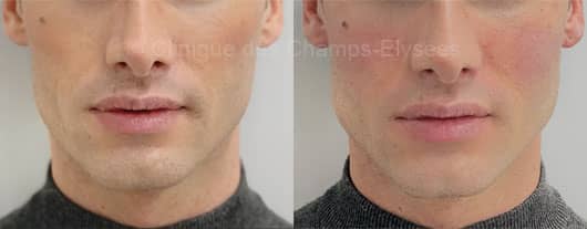 Jawline Contouring à l'acide hyaluronique à Paris et en France