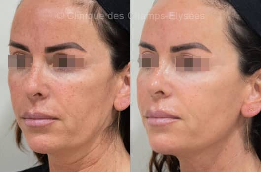 Avant-après Jet Peel