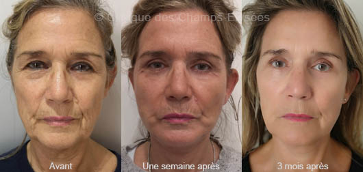 Avant-après lifting du visage : De face