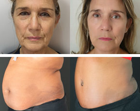 Avant-après chirurgie