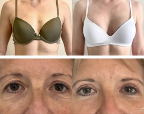 Avant-après chirurgie