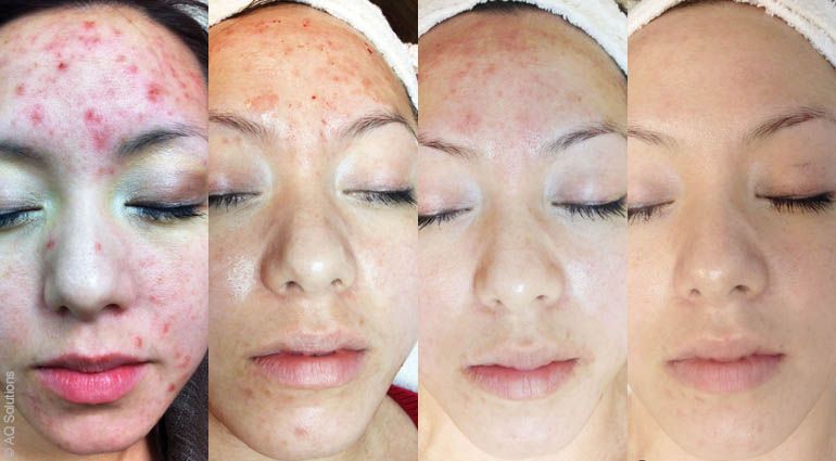 AQ SkinnSolutions : acné