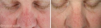 Traitement rougeurs sur le visage avec HydraFacial®