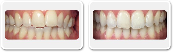 Amélioration de l’alignement des dents