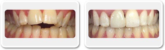 Amélioration de l’alignement des dents