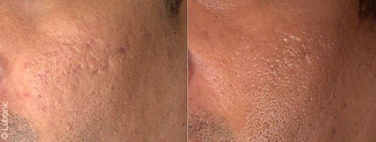Atténuation des cicatrices d'acné