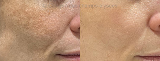 Atténuation du melasma