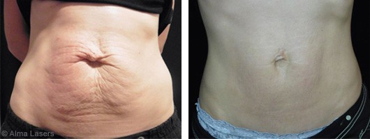 Raffermissement du ventre avec Legato™ III