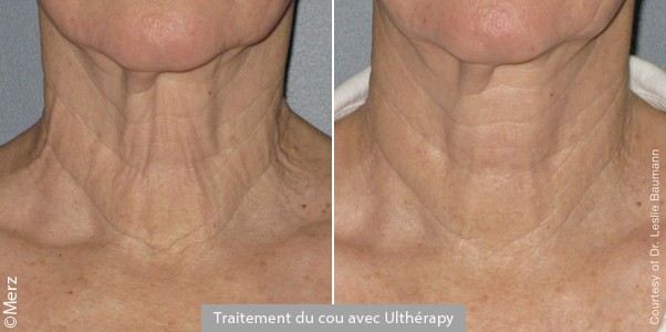 Rajeunissement du cou avec Ulthera®