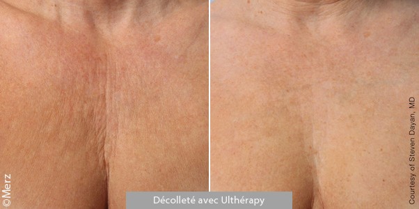 Défroissement du décolleté avec Ulthera®