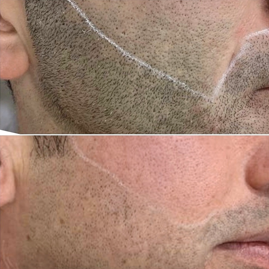 Epilation laser Homme : Barbe