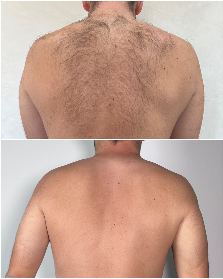Epilation laser Homme : Le dos et les épaules