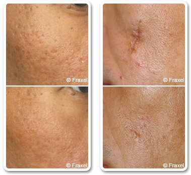 Traitement des cicatrices avec le laser Fraxel®