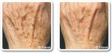 Traitement taches brunes avec le laser Fraxel®