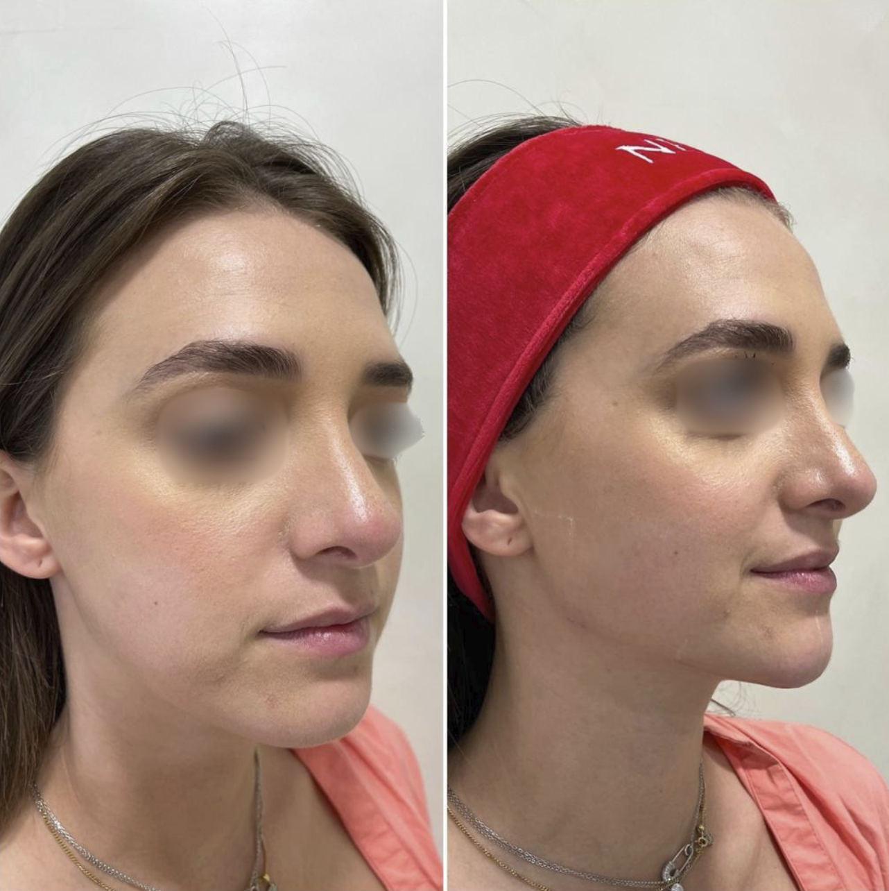 Jawline Contouring - Clinique des Champs-Elysées Nice