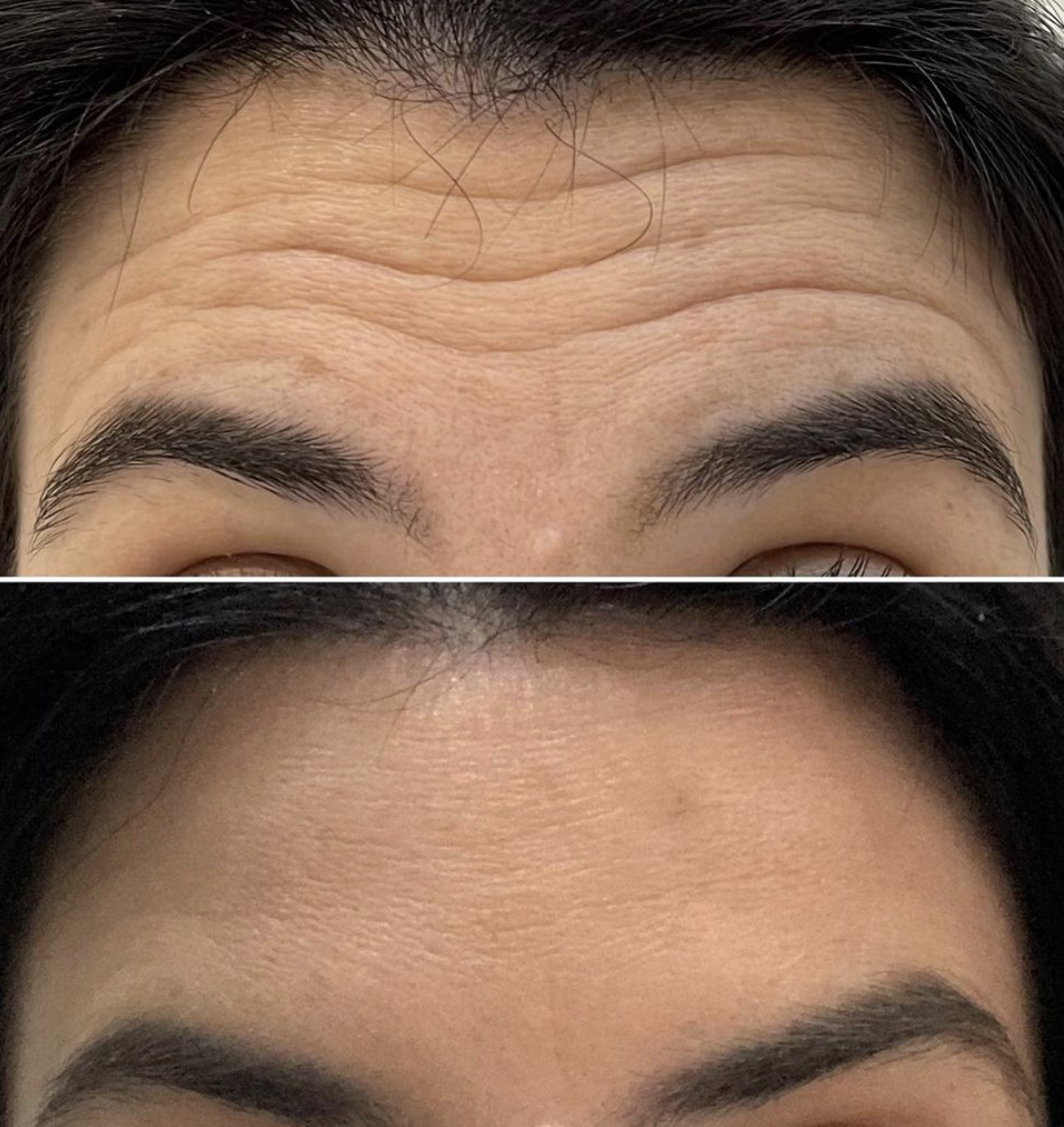 Injection de Botox front - Clinique des Champs-Elysées Paris