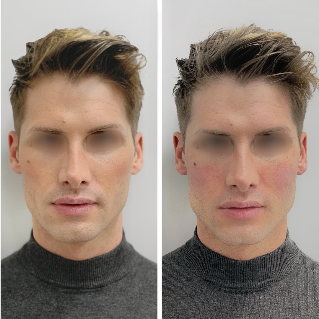 Jawline Contouring - Clinique des Champs-Elysées Paris