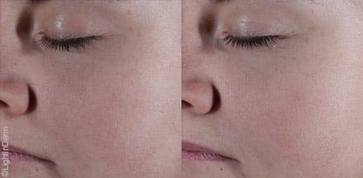 Programme éclat du teint : LightinDerm Brightening