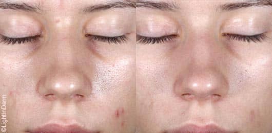 Programme anti-imperfections : LightInDerm Purity