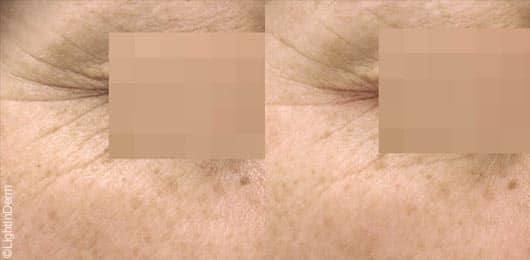 Programme anti-âge : LightinDerm Repair