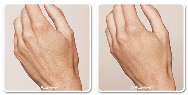 Rajeunissement des mains avec Skinbooster®