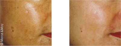 Traitement de l’hyperpigmentation