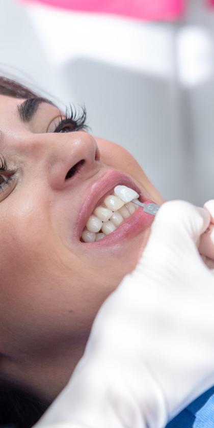 Blanchiment des dents avec gouttière (dents jaunes) à Paris, Technique et  prix