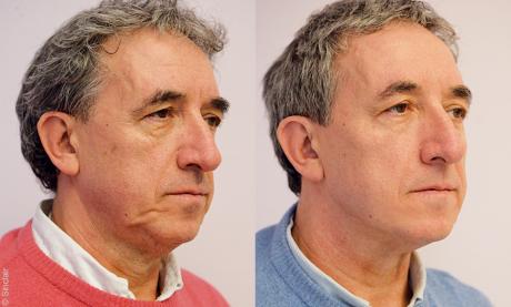 Fils tenseurs pour le rajeunissement du visage
